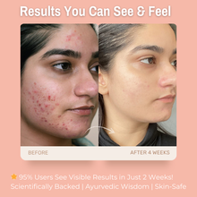 Load image into Gallery viewer, 2% Niacinamide and 1% Salicylic Acid Anti-Acne Cream | Reduces Acne &amp; Blemishes effectively | 50 ml