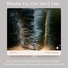 Load image into Gallery viewer, 1% Zinc Pyrithione + 1% Salicylic Acid + 2% Tea Tree Anti-Dandruff Shampoo | Removes Dandruff &amp; Soothes Itchy Scalp| For Flake-Free &amp; Healthy Hair