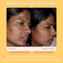 Load image into Gallery viewer, 2% Alpha Arbutin + 1% Kojic Acid De-Pigmentation Cream | Reduces Hyperpigmentation &amp; Dark Spots