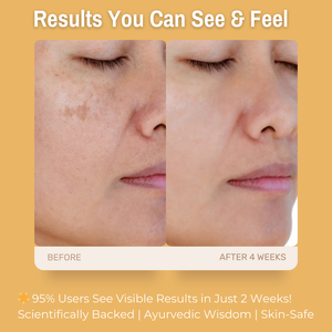 5% Vitamin C + 5% Lemon Brightening & Hydrating Gel Moisturizer | Fades Dark Spots & Evens Skin Tone