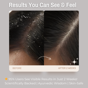 1% Zinc PCA + 2% Tea Tree + 4% Neem Anti-Dandruff Hair Conditioner | Reduces Dandruff and Soothes Scalp