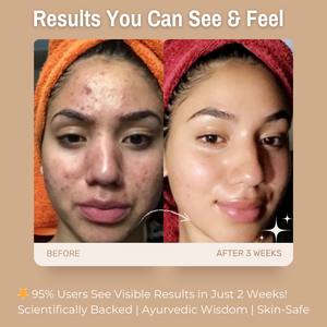 2% Salicylic Acid + 5% Niacinamide Anti-Acne Face Serum | with Zinc & Tea Tree | Clears Acne & Dark Spots, Controls Oil & Reduces Inflammation
