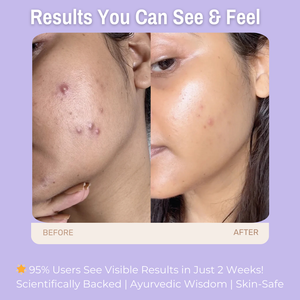 2% Salicylic Acid + 2% Niacinamide + 1% Zinc PCA Anti-Acne Face Wash | Deep Cleansing, Pore Unclogging, Oil Control & Breakout Care