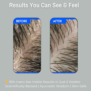 1% Salicylic Acid + 4% Witch Hazel Scalp Clarifying Foaming Hair Wash | Controls Dandruff, Regulates Oil & Promotes Healthy Scalp