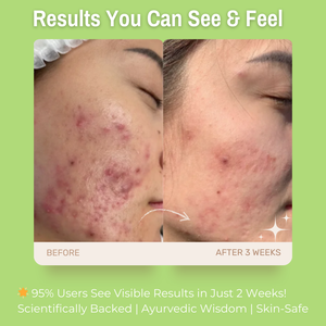 2% Salicylic Acid + 5% Matcha Tea + 10% French Green Clay Anti-Acne Face Pack | Deep Detox & Oil Control