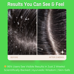 1% Salicylic Acid + 2% Zinc Anti-Dandruff Hair Serum | with Allantoin & Fenugreek | Reduces Dandruff, Soothes Irritation & Controls Sebum